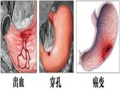 胃、十二指肠溃疡出血