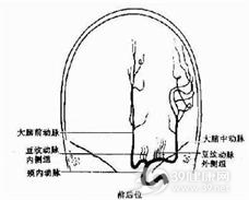 外伤后颈内动脉闭塞