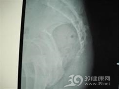尾神经丛痛
