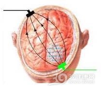 外伤性癫痫