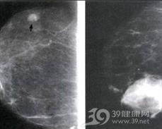 外伤性乳房血肿
