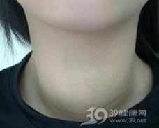 无痛性甲状腺炎