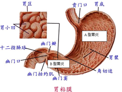 胃炎