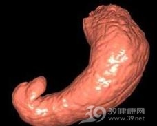 胃脂肪瘤