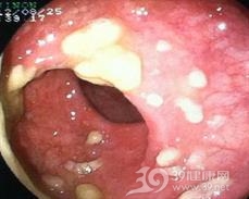 胃真菌病