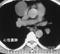 心包囊肿