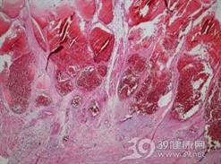 胸壁深部软组织感染