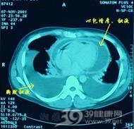 心包炎