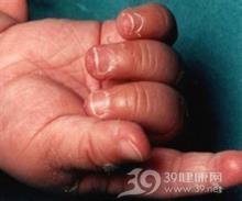 小儿α1-抗胰蛋白酶缺乏症