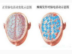 小儿癫痫