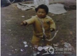 小儿肥胖症