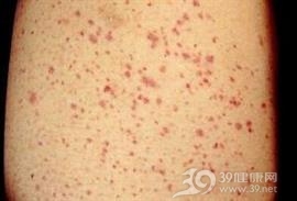 小儿过敏性紫瘢