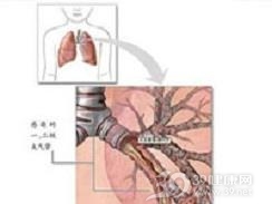 小儿急性支气管炎