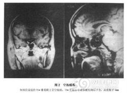 小儿空鞍综合征