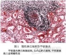 小儿慢性淋巴细胞性甲状腺炎