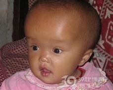 小儿脑积水