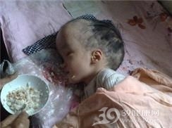 小儿脑瘫