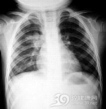 小儿脱屑性肺炎