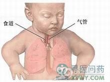 小儿外源性变应性肺泡炎