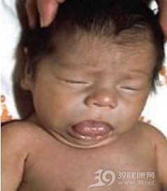 小儿先天性甲状腺功能减低症