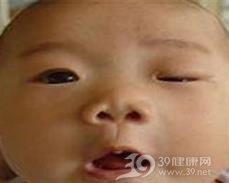 小儿先天性面肌双瘫综合征