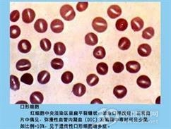 小儿遗传性口形细胞增多症