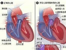 心房内折返性心动过速