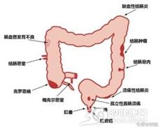 消化道出血