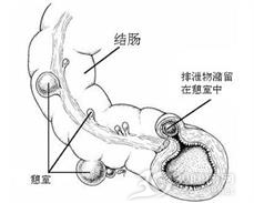 消化道憩室病