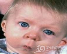小颌畸形综合征