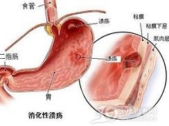 消化性溃疡