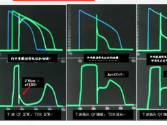 心肌桥