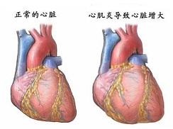 心肌炎