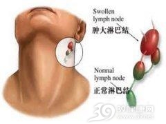 腺淋巴瘤