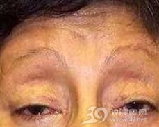 线粒体脑肌病