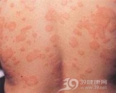 荨麻疹性血管炎