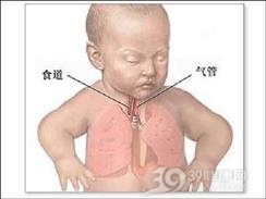 吸入性肺炎