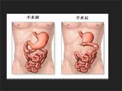 吸收不良综合征