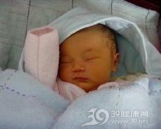 新生儿生理性黄疸
