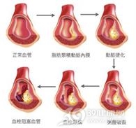 血栓形成