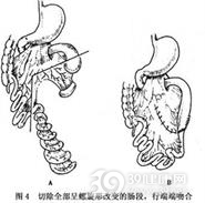 先天性肠闭锁与狭窄