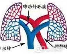 先天性肺动静脉瘘