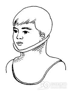 先天性肌性斜颈