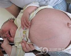 先天性肾病综合征