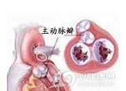 先天性主动脉瓣窦动脉瘤破裂