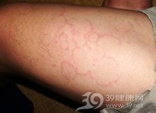 小舞蹈病
