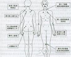 纤维肌痛综合征
