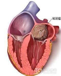 心脏黏液瘤