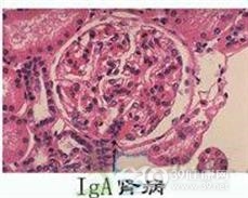 选择性IgA缺乏症