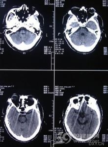 遗传性多发脑梗死性痴呆